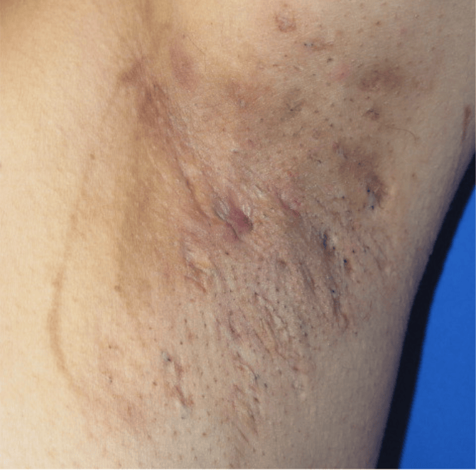 Thumbnail of the Hidradenitis suppurativa example image
